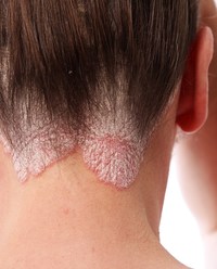 Schuppenflechte Psoriasis