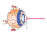 Augenarzt Barmbek Laserbehandlungen